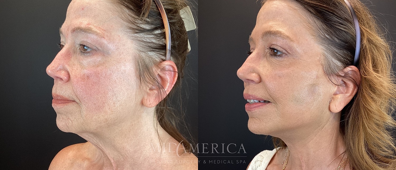 Facelift Before & After