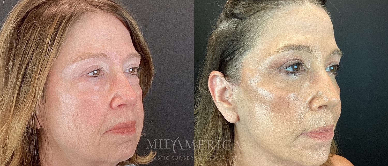Facelift Before & After