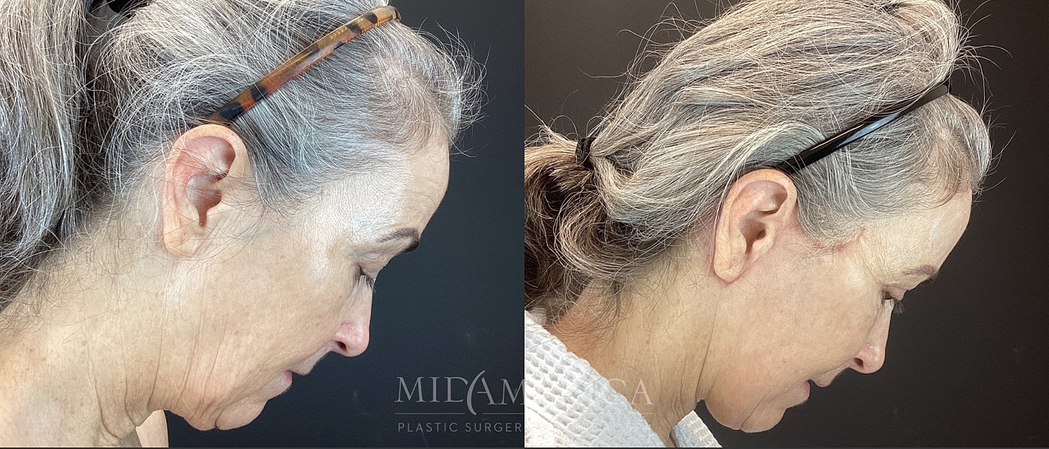 Facelift Before & After