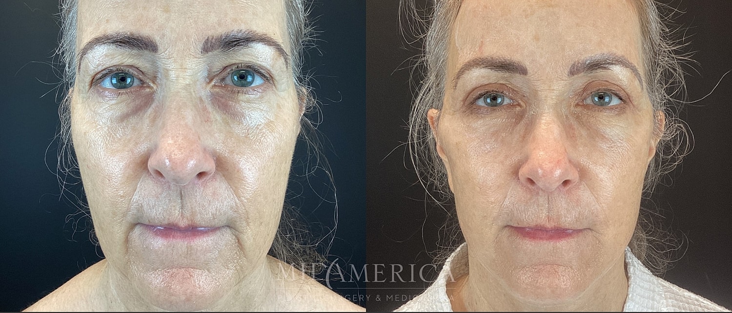 Facelift Before & After