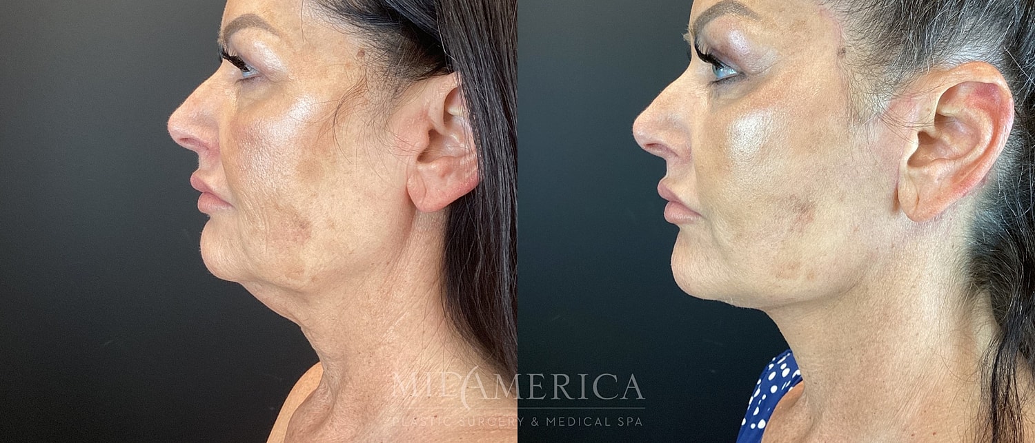 Facelift Before & After
