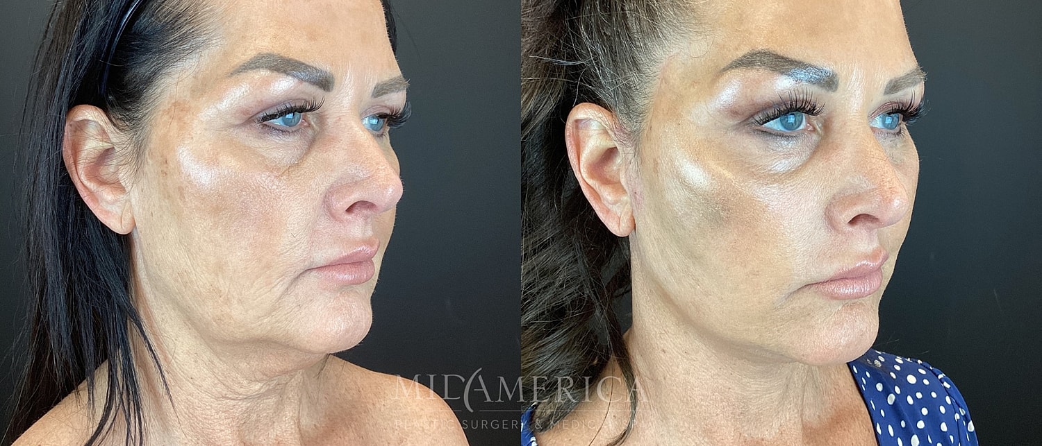 Facelift Before & After