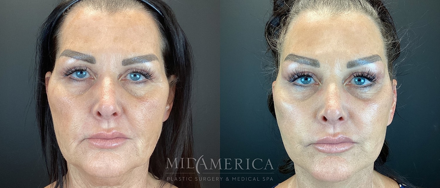 Facelift Before & After