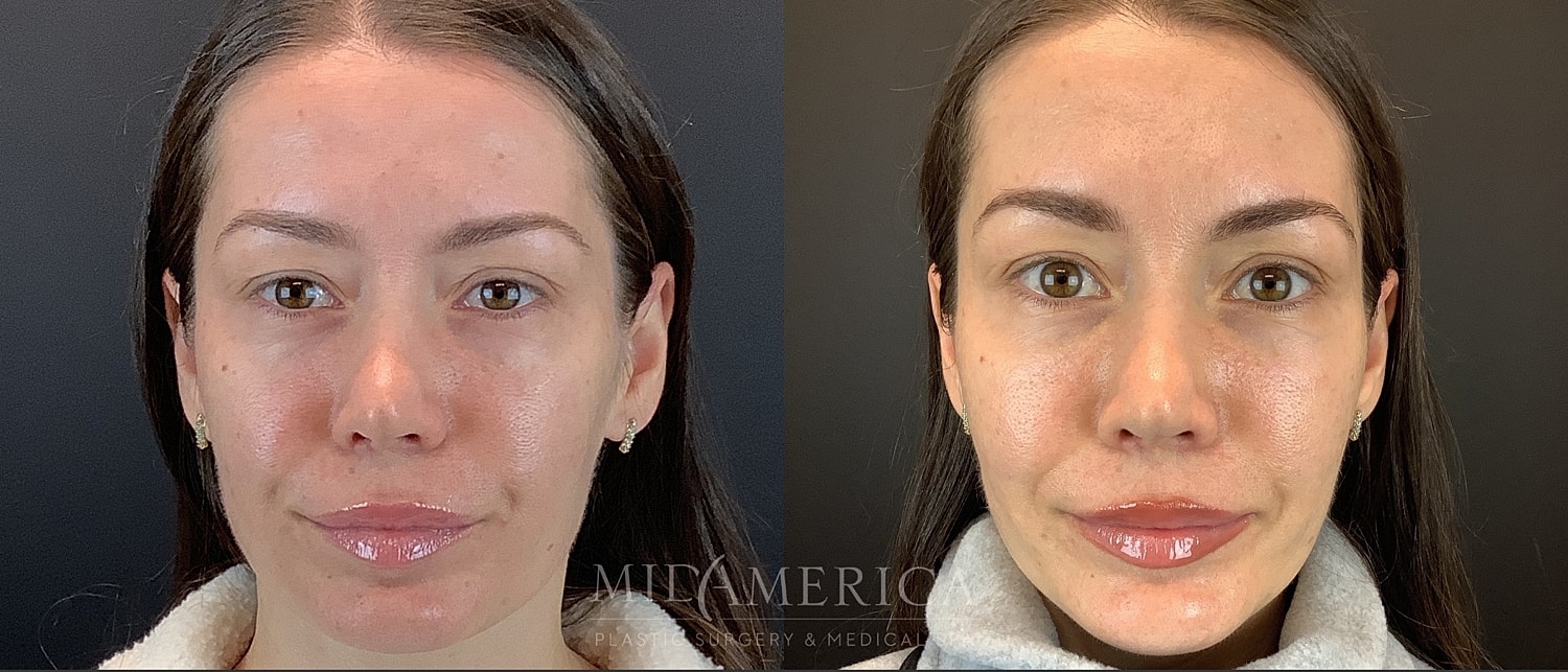 Cheek Filler Before & After