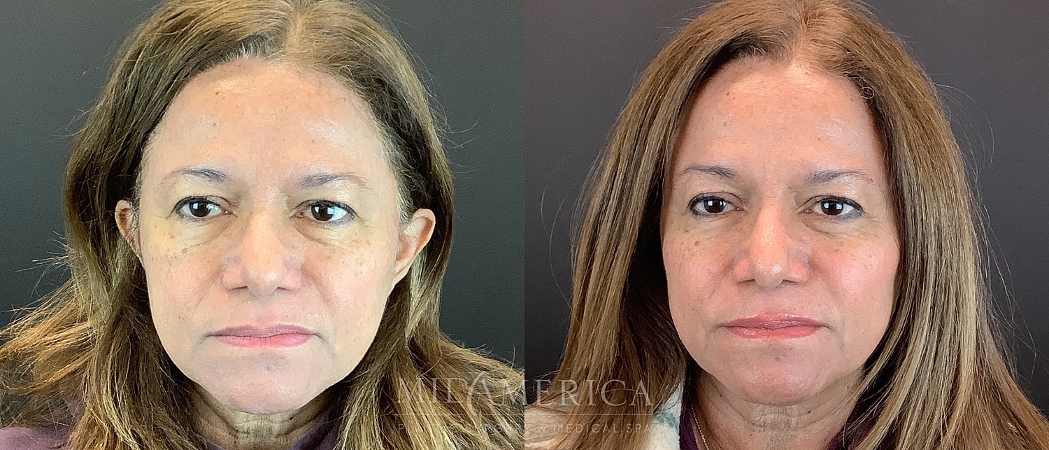 Before and after facial treatment comparison.