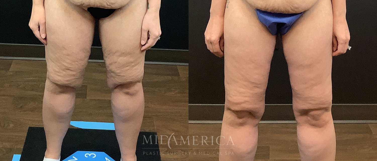 Thigh Lift Before & After