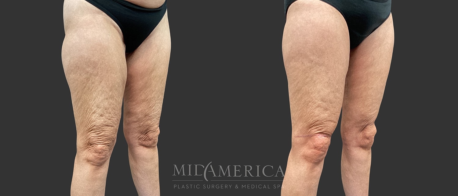 Thigh Lift Before & After