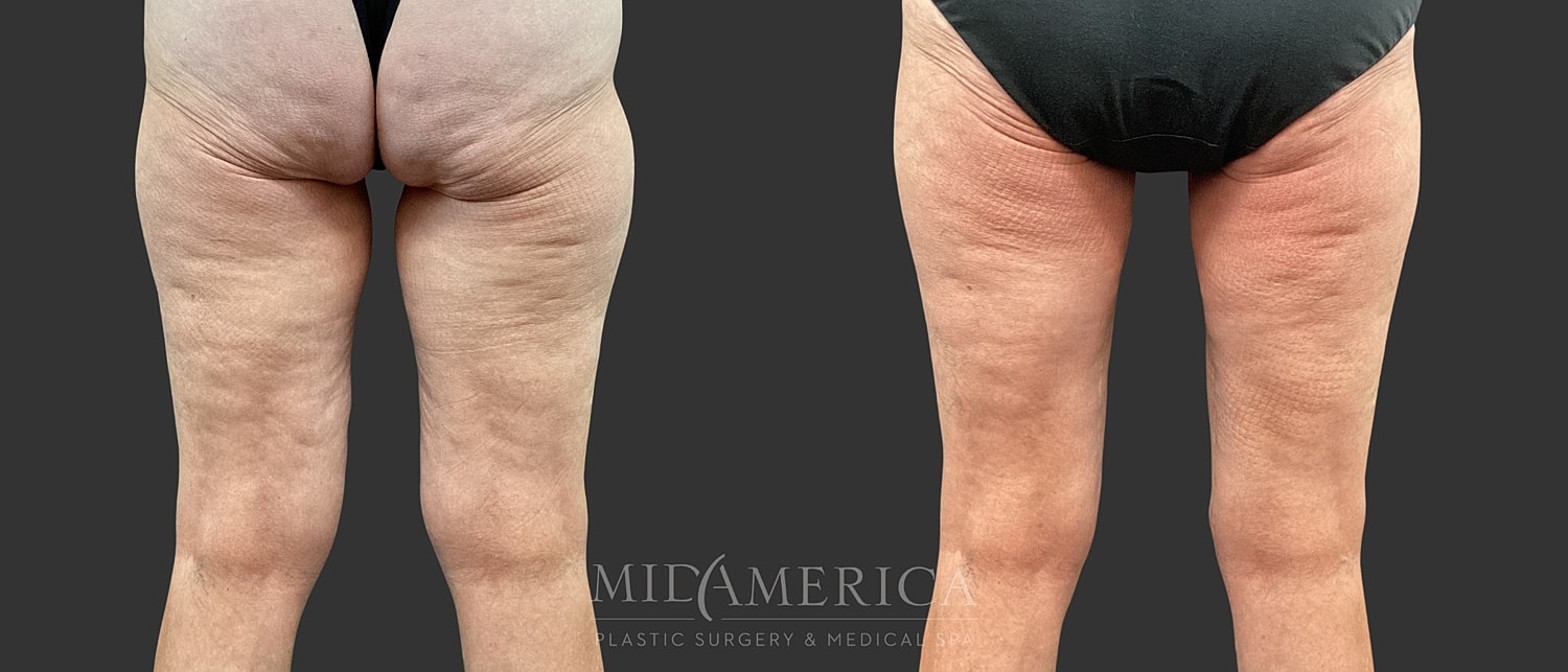 Thigh Lift Before & After