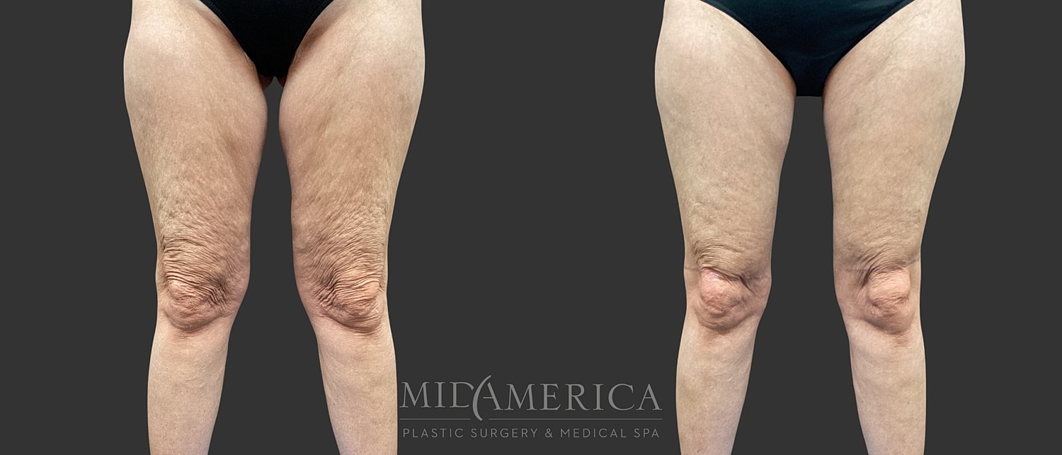 Thigh Lift Before & After