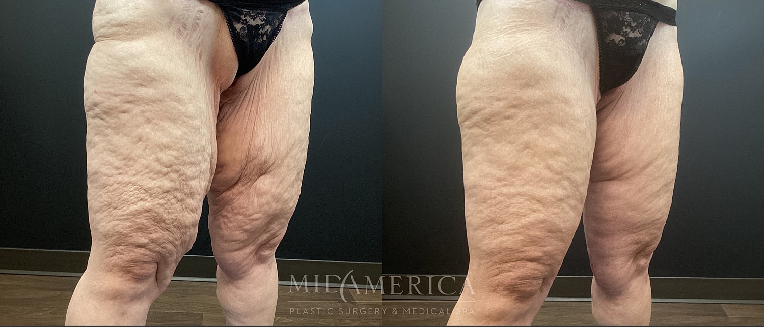 Thigh Lift Before & After