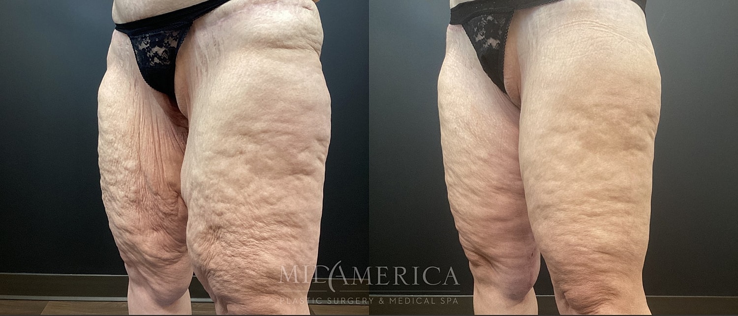 Thigh Lift Before & After