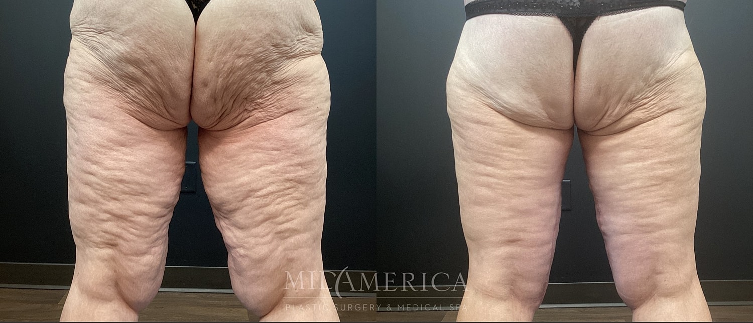 Thigh Lift Before & After