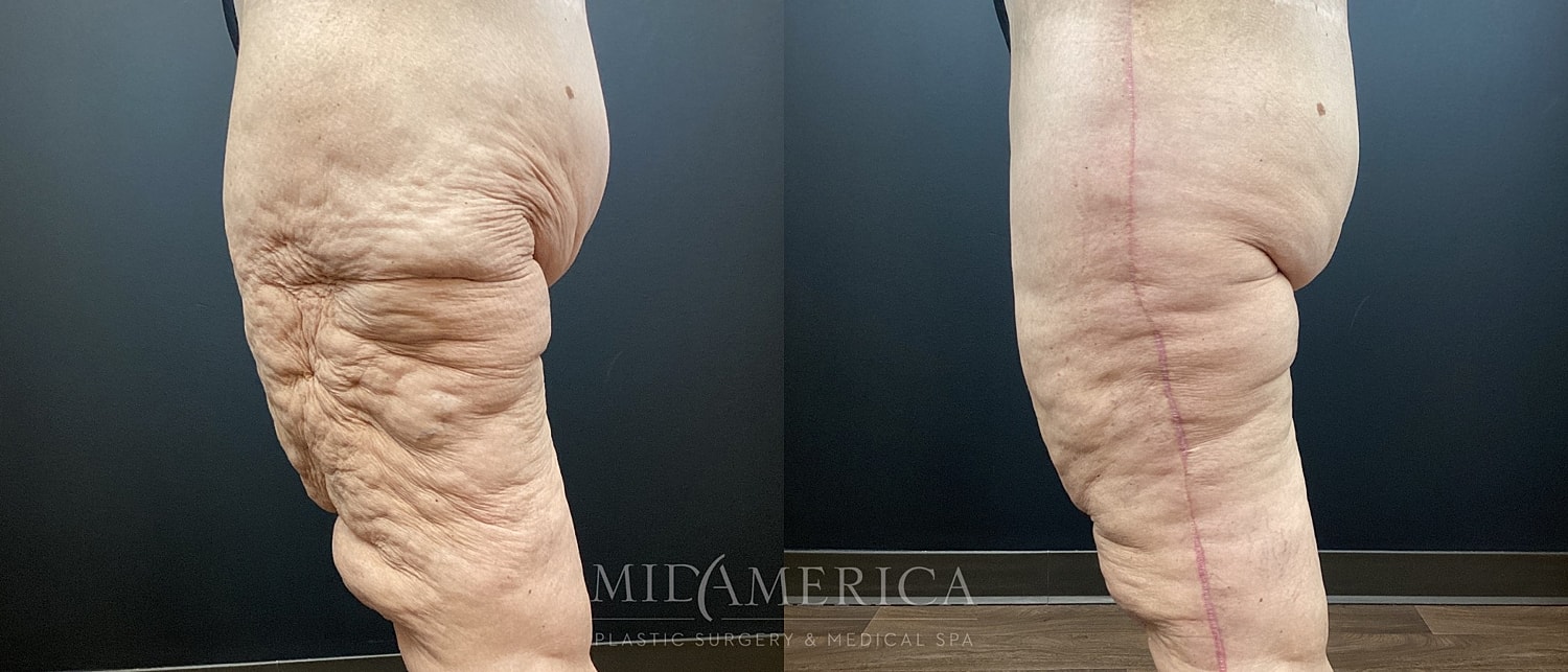 Before and after leg skin smoothing treatment.