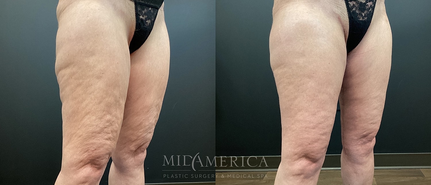 Before and after of thigh treatment results.