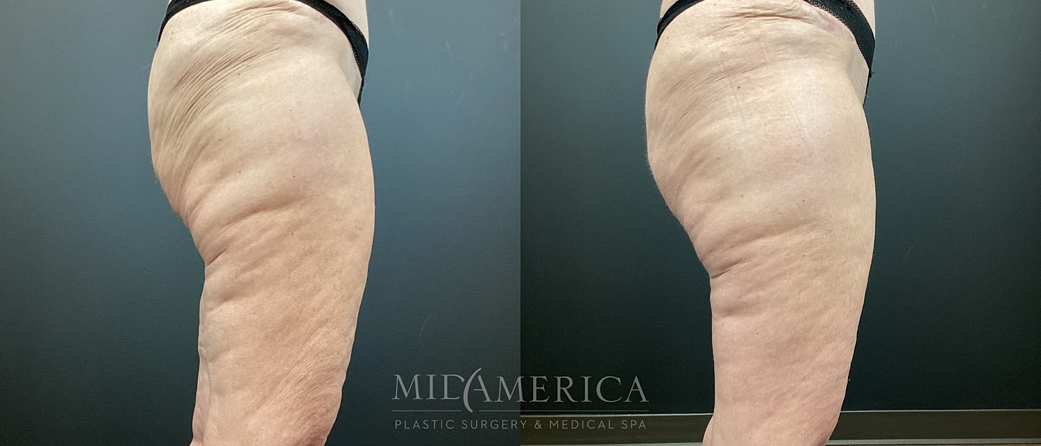 Before and after images of arm treatment.