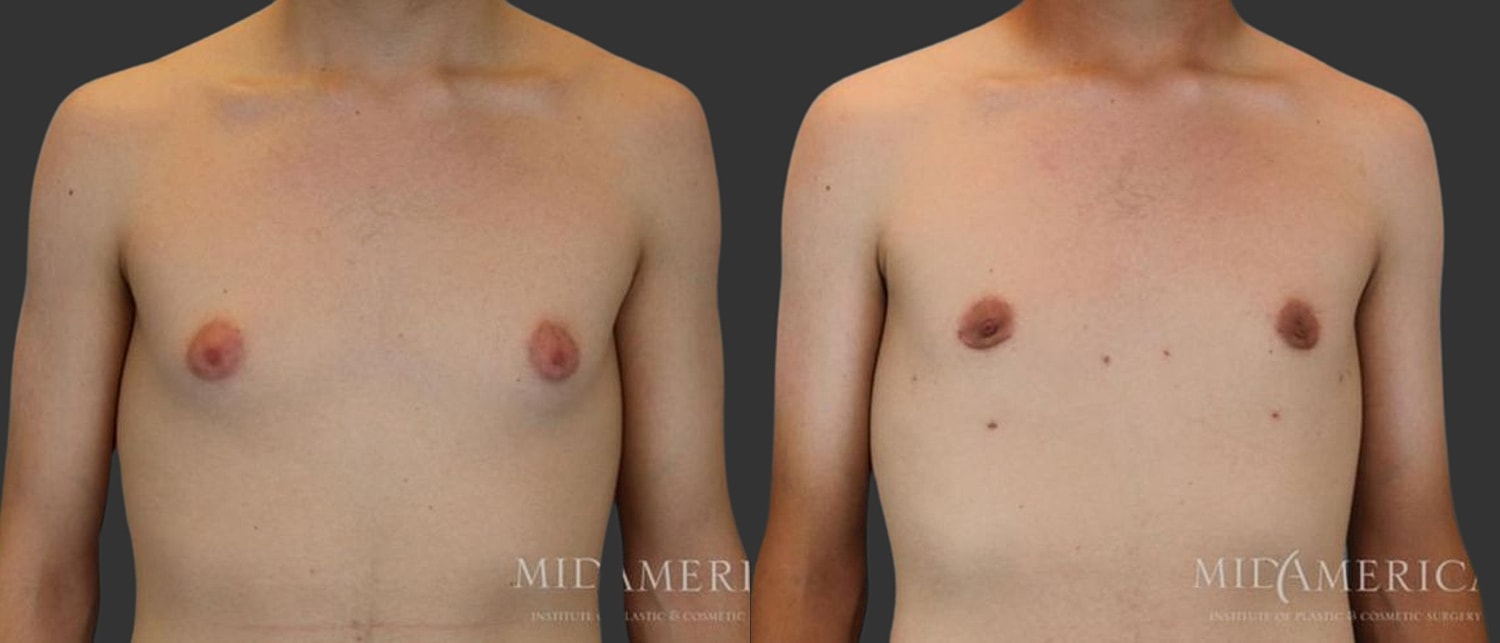 Gynecomastia Before & After