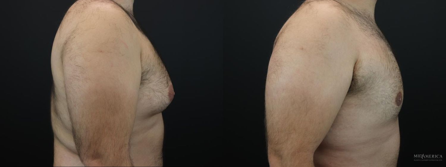 Gynecomastia Before & After