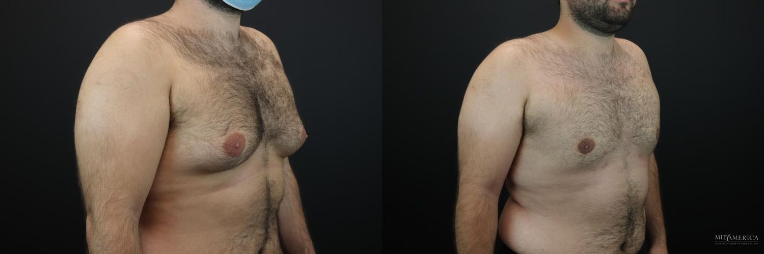 Gynecomastia Before & After
