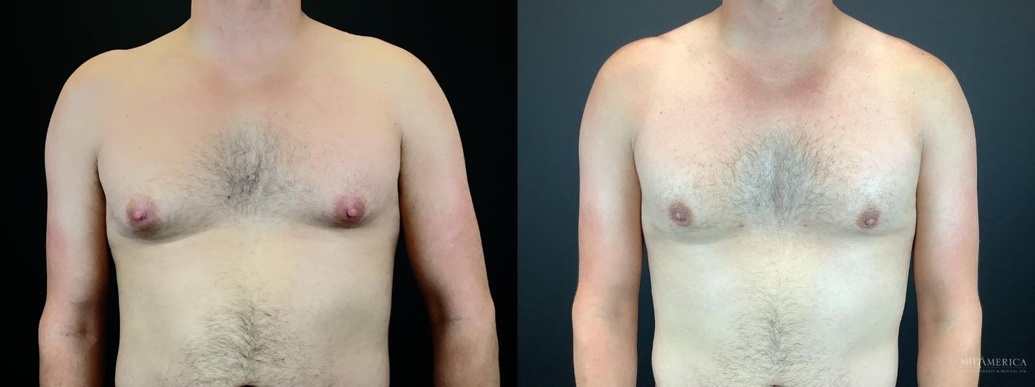 Gynecomastia Before & After