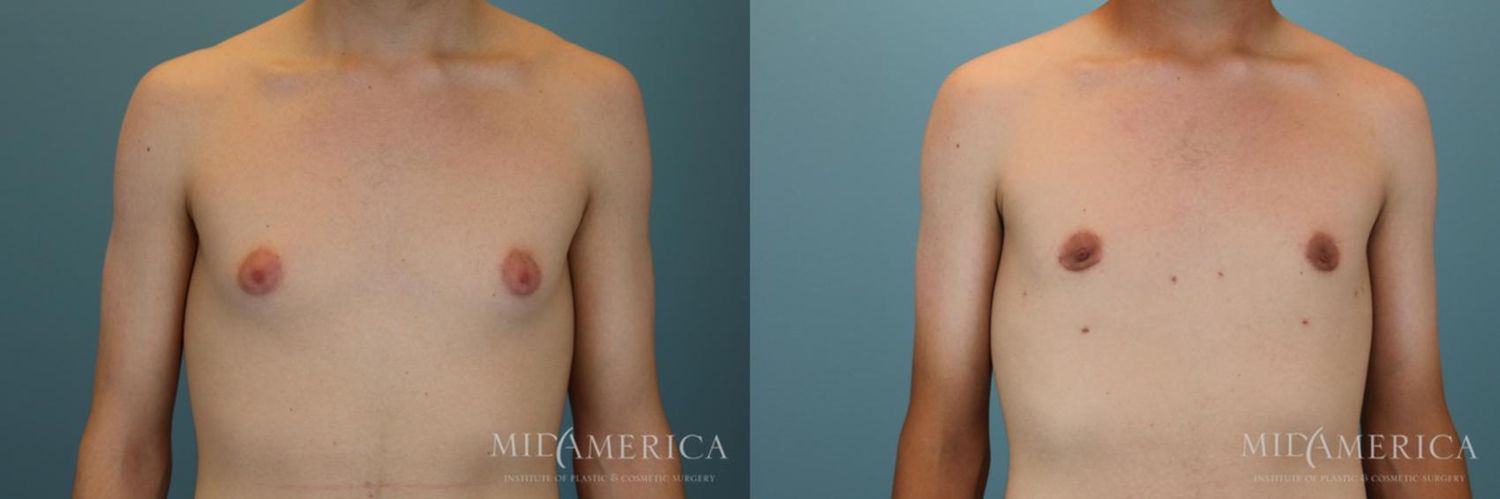 Gynecomastia Before & After
