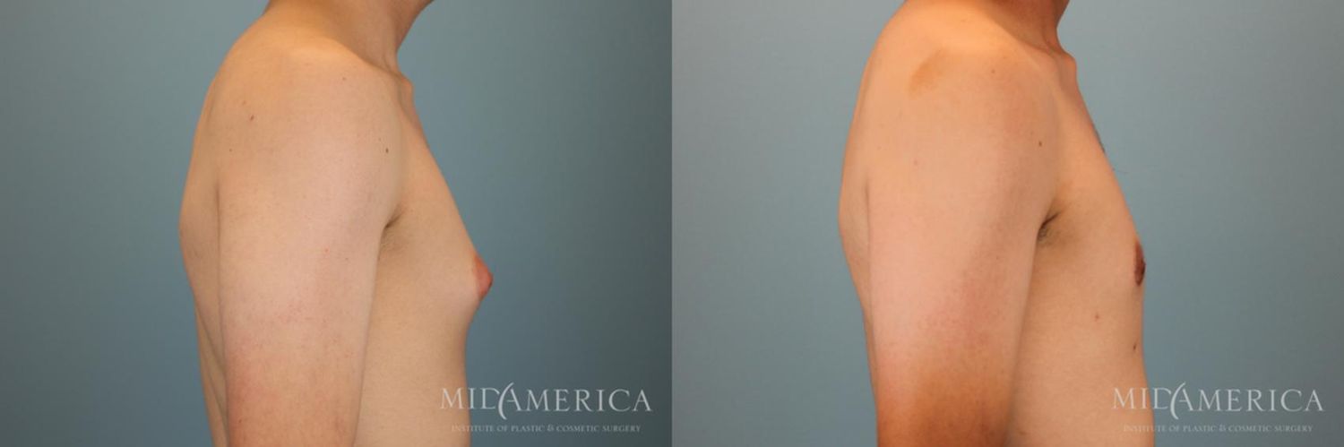 Gynecomastia Before & After