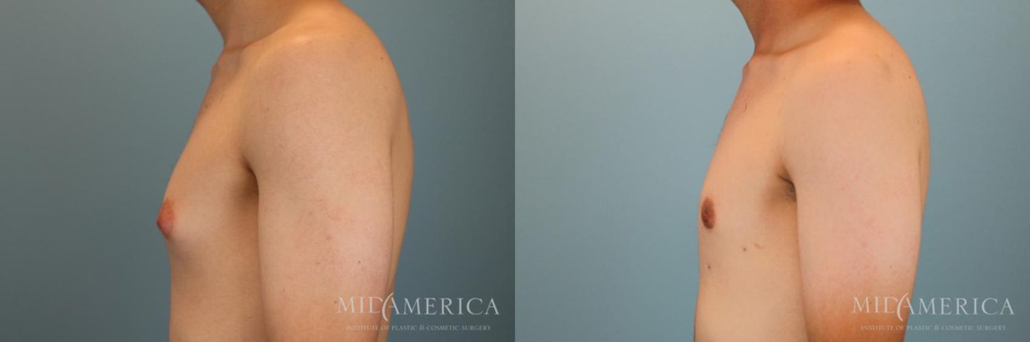 Gynecomastia Before & After