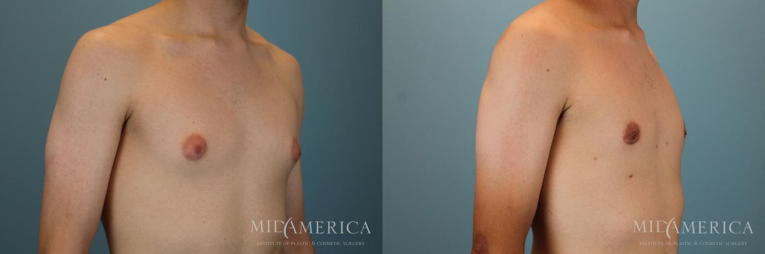 Gynecomastia Before & After