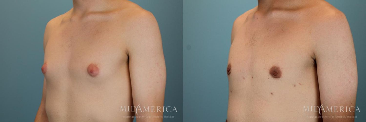 Gynecomastia Before & After