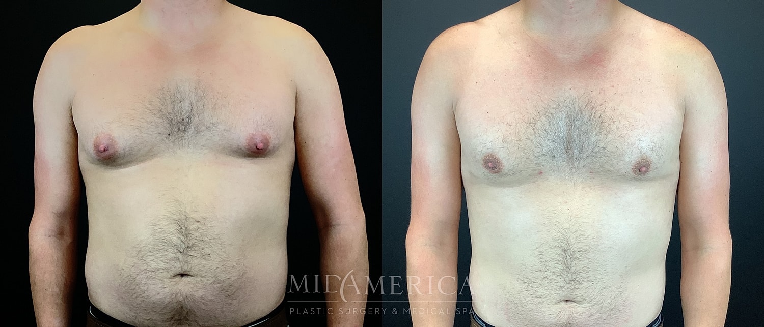 Gynecomastia Before & After
