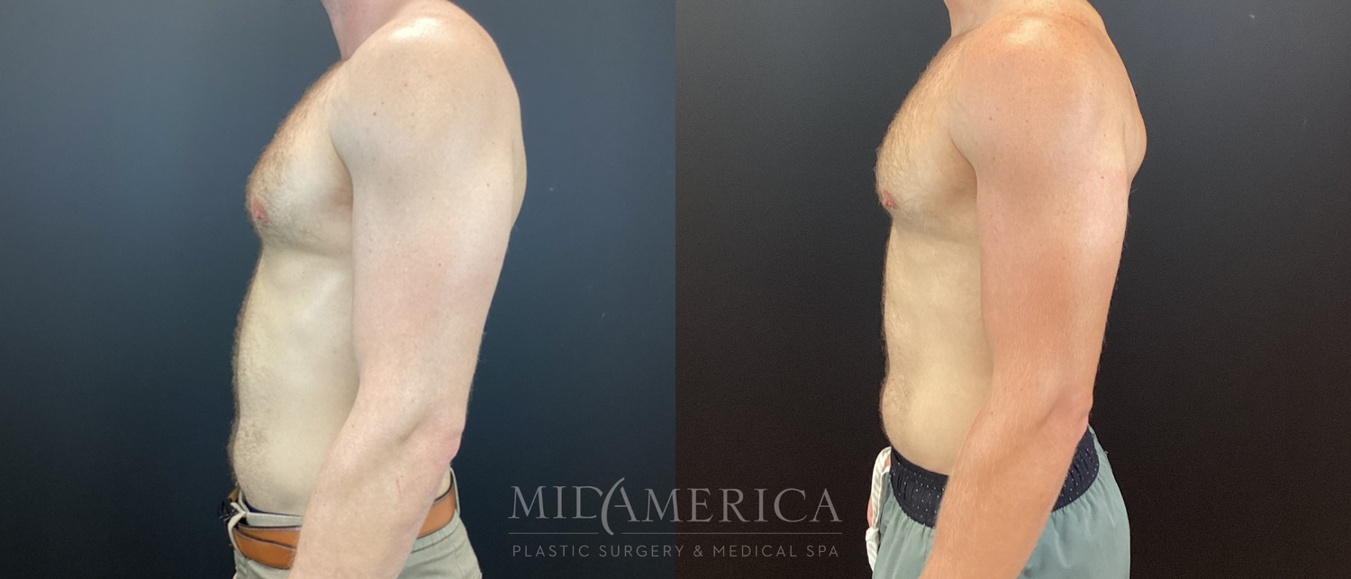 Gynecomastia Before & After