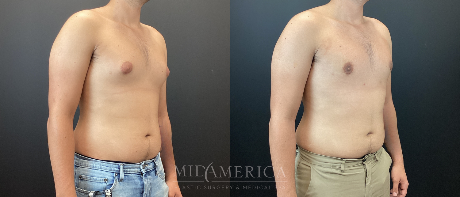 Gynecomastia Before & After