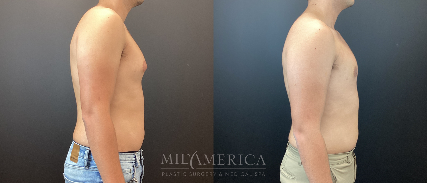 Gynecomastia Before & After