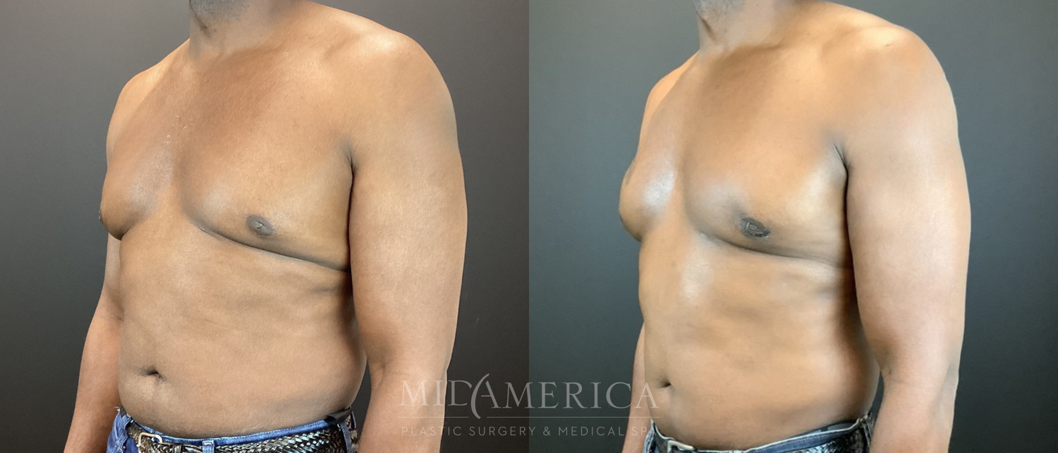 Gynecomastia Before & After