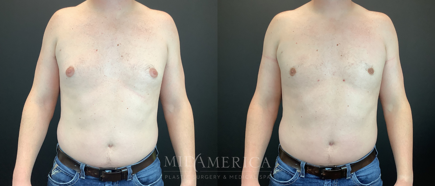 Gynecomastia Before & After