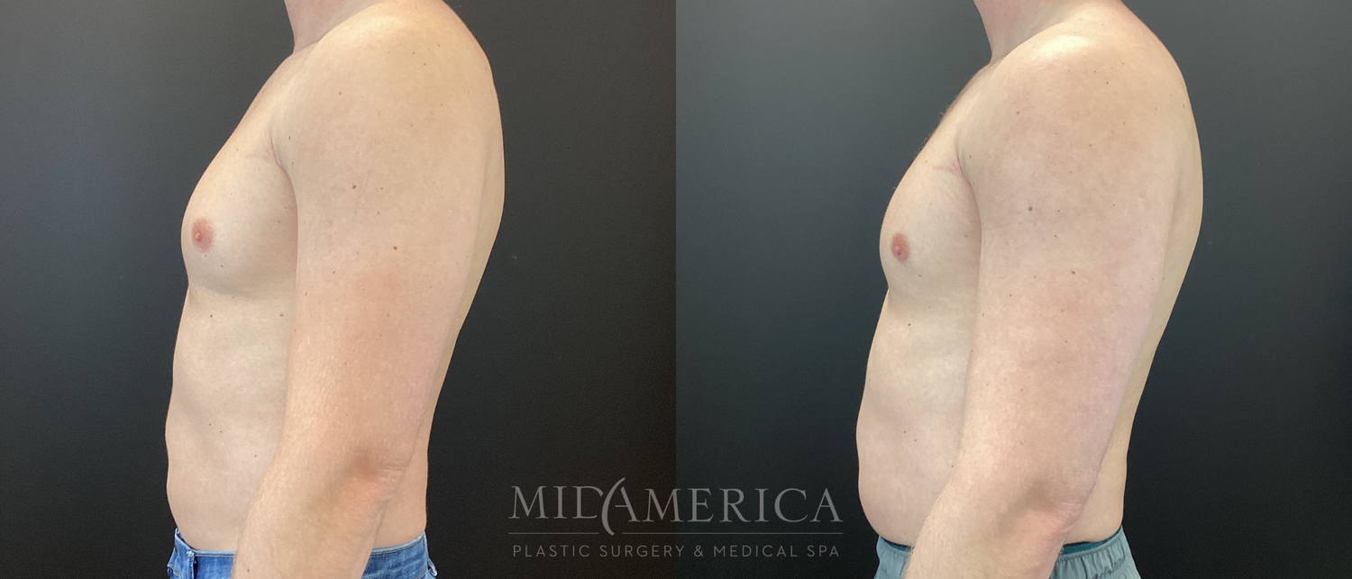 Gynecomastia Before & After
