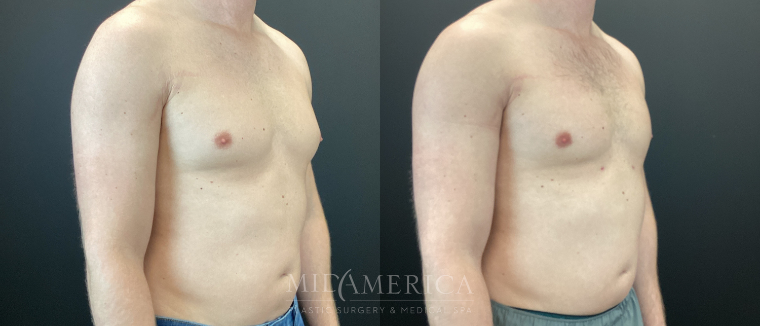 Gynecomastia Before & After