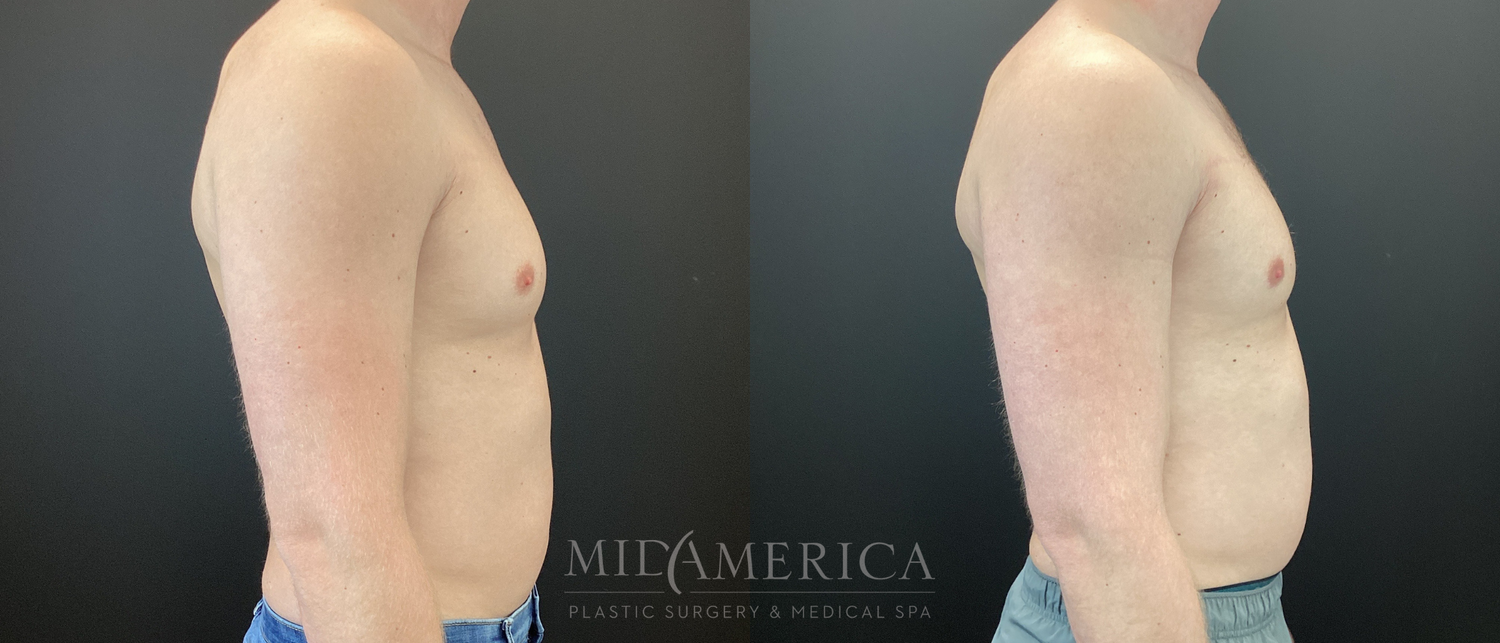 Gynecomastia Before & After