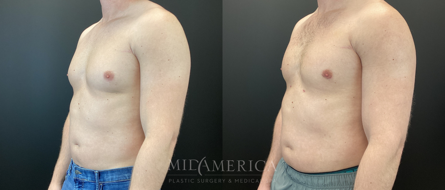 Gynecomastia Before & After