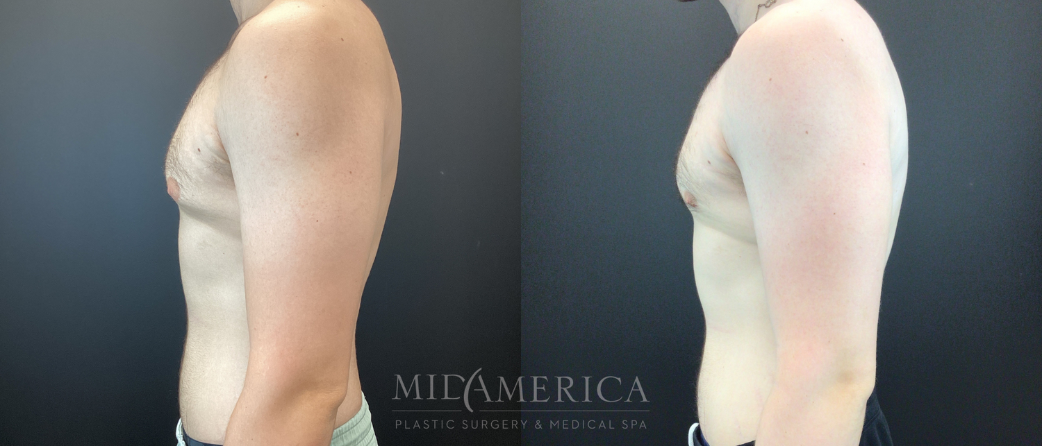 Gynecomastia Before & After
