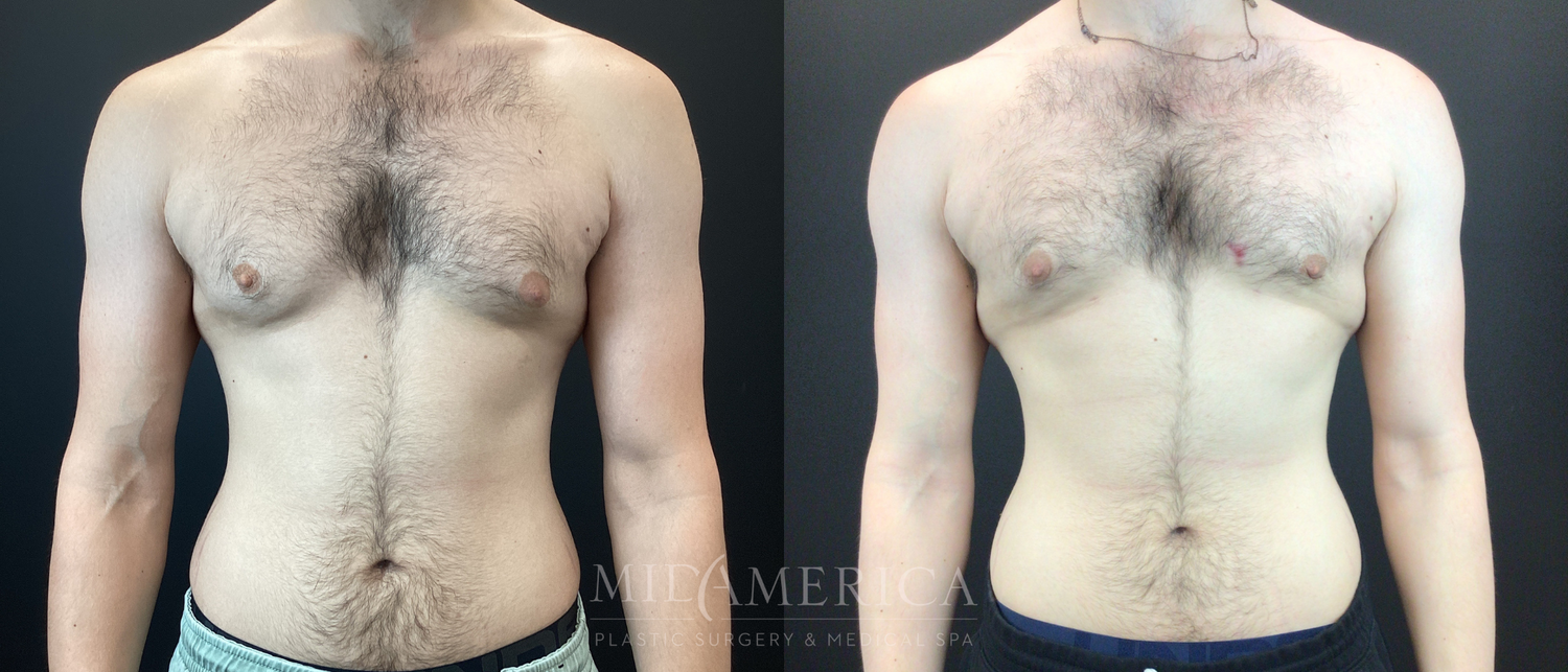 Gynecomastia Before & After