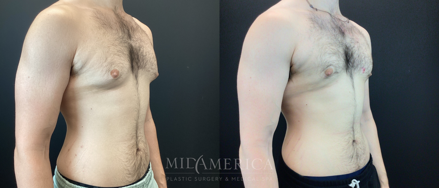 Gynecomastia Before & After