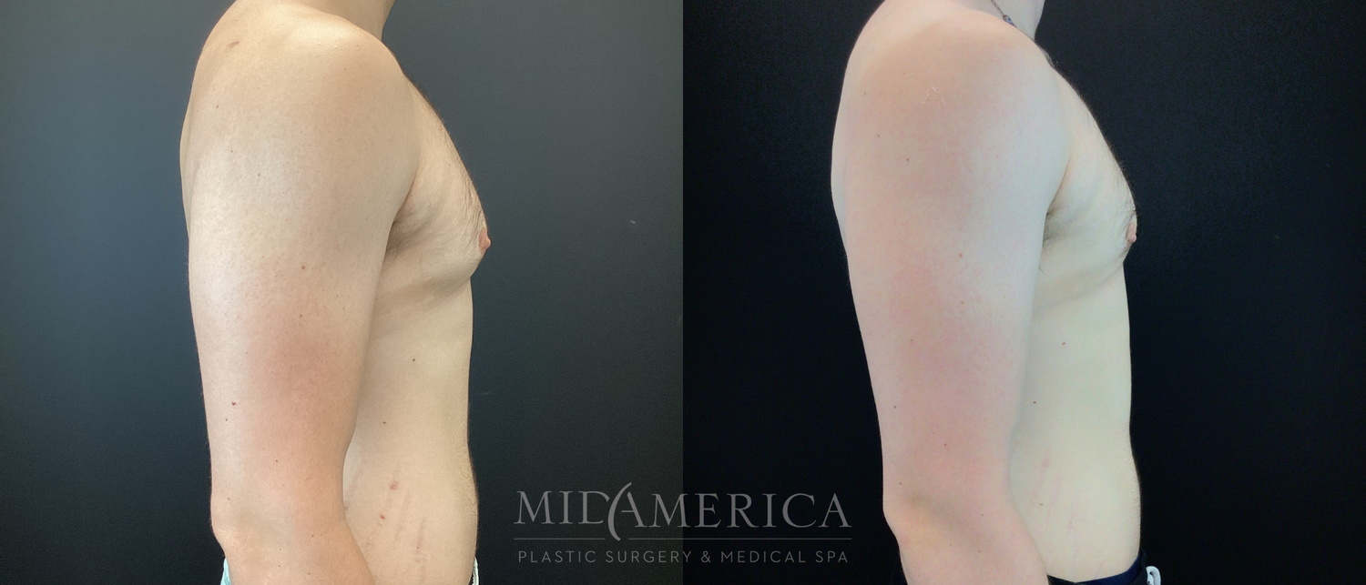 Gynecomastia Before & After