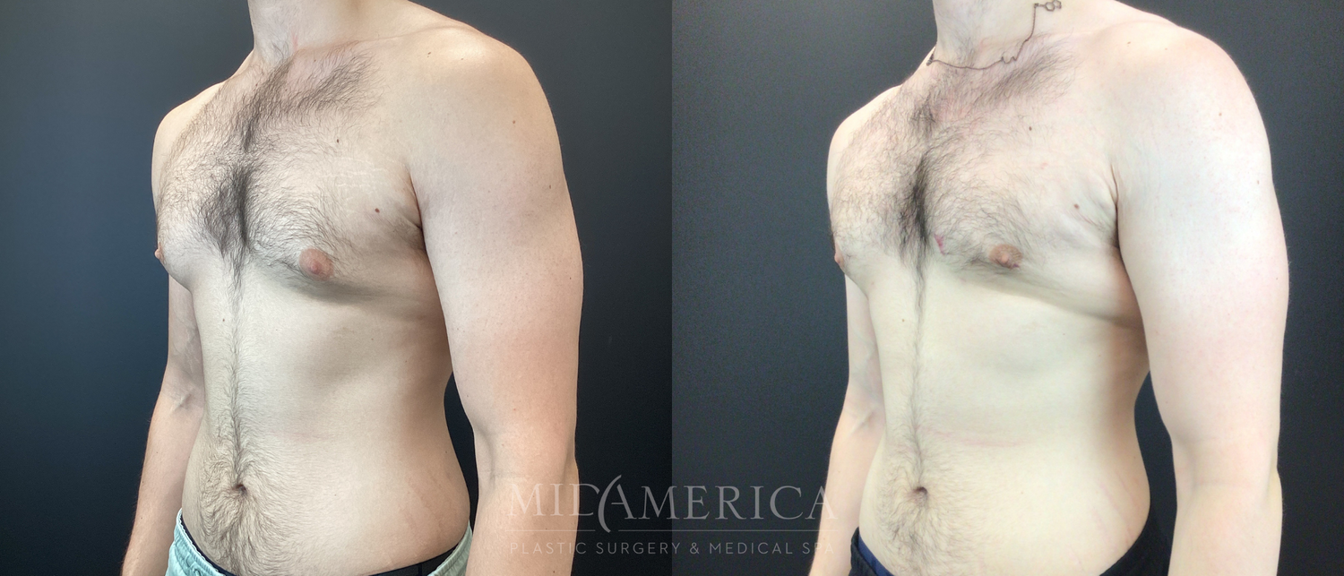 Gynecomastia Before & After