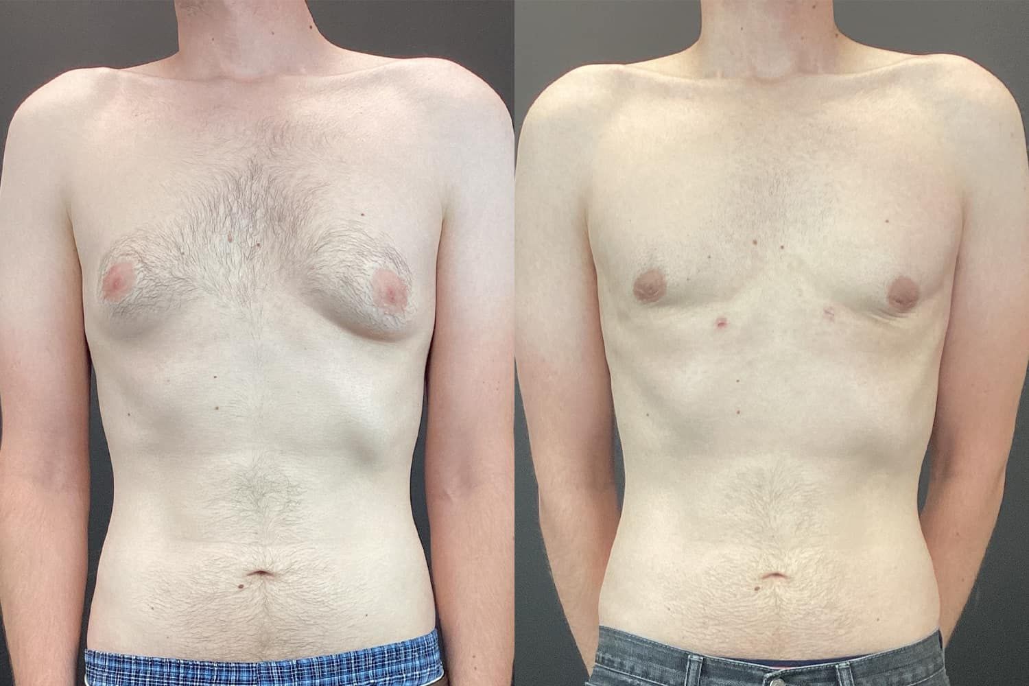 Gynecomastia Before & After