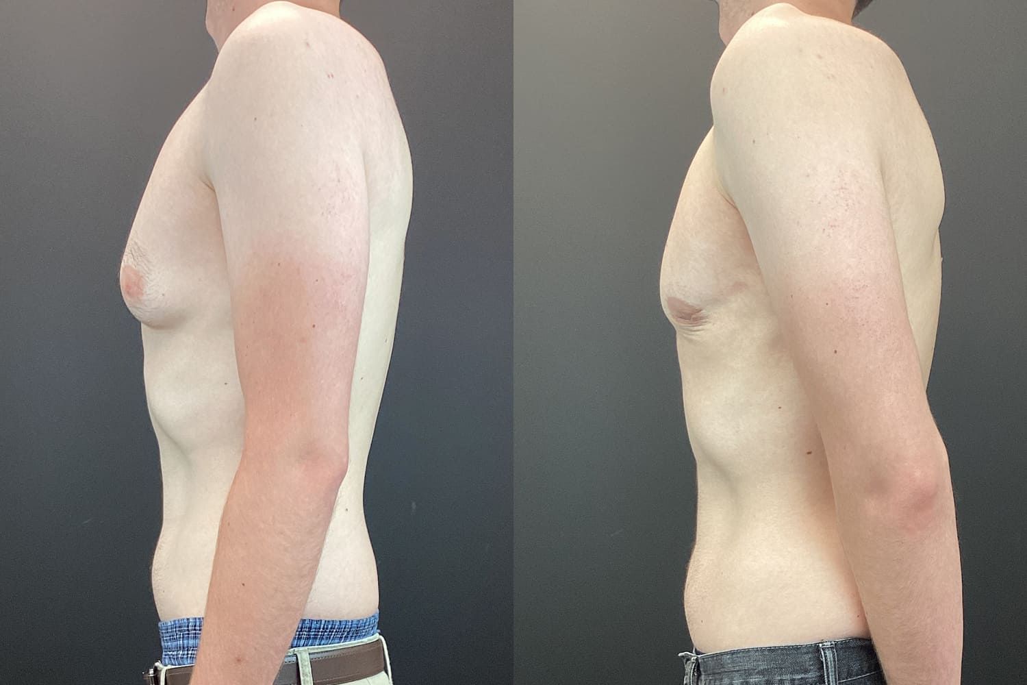 Gynecomastia Before & After