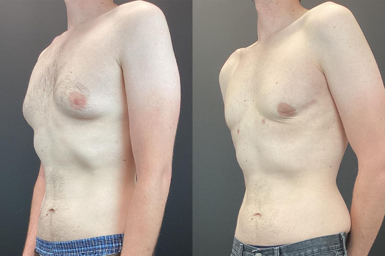 Gynecomastia Before & After
