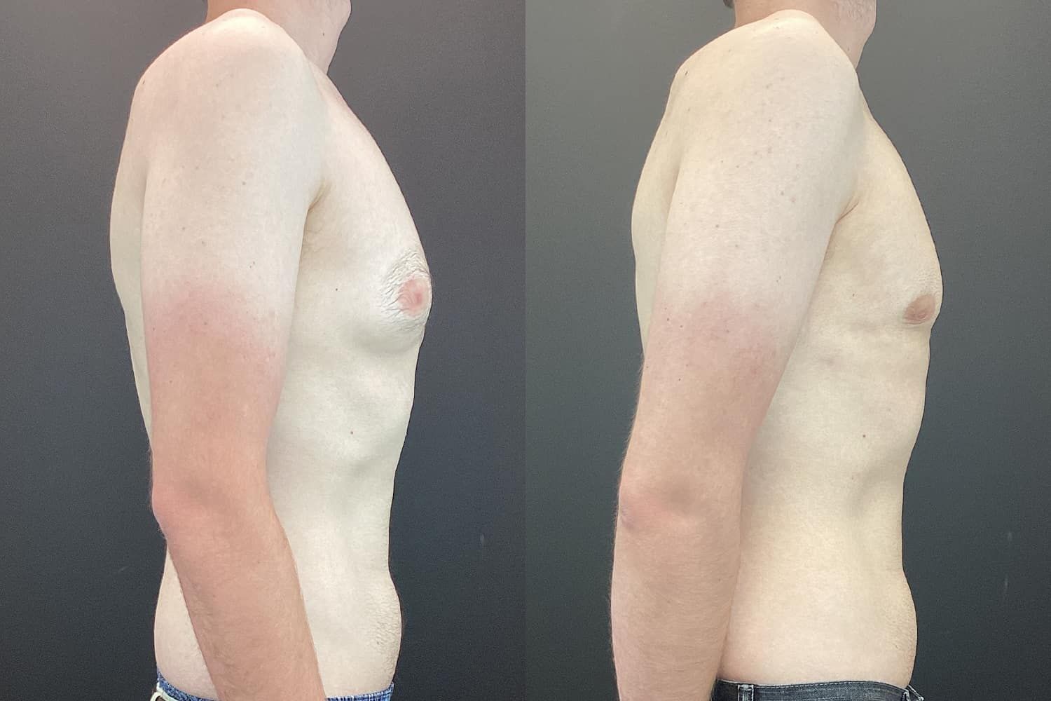 Gynecomastia Before & After