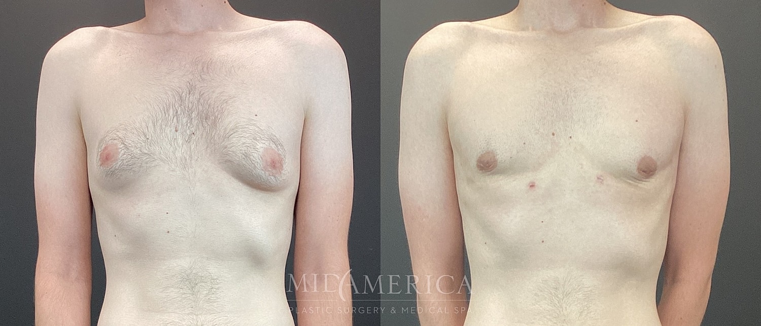 Gynecomastia Before & After