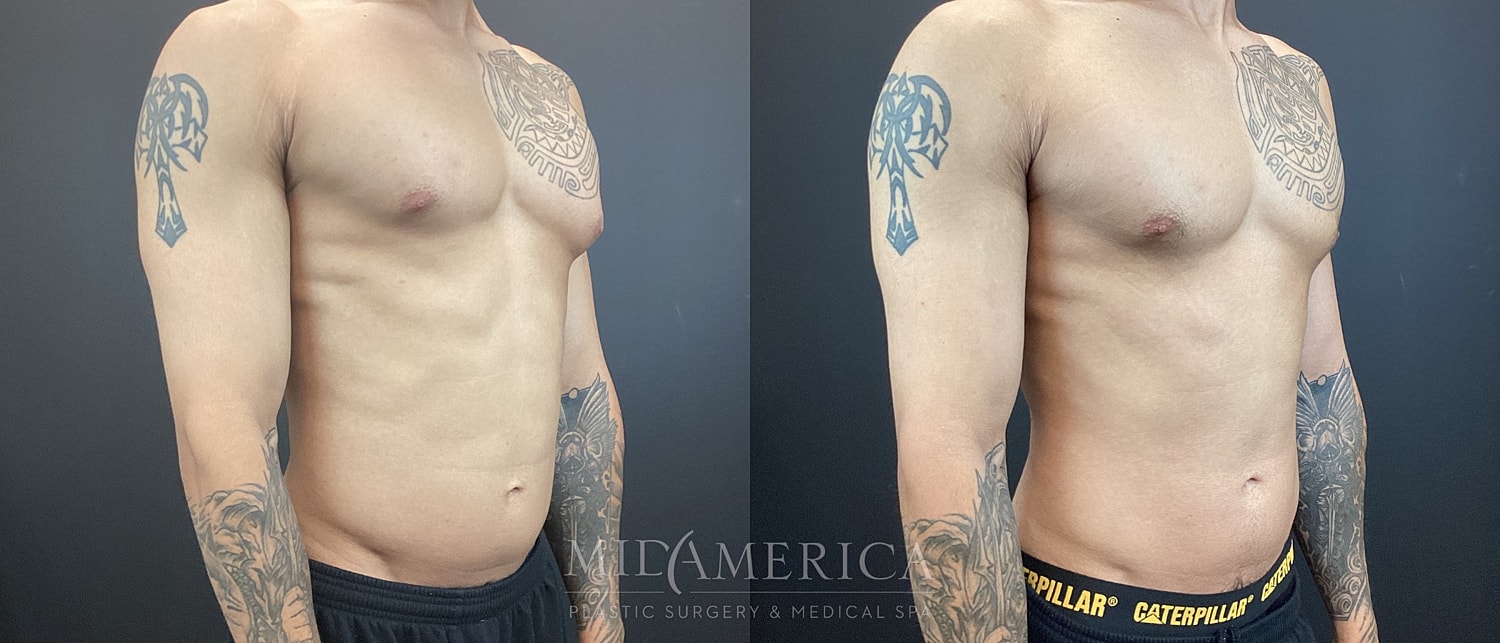 Gynecomastia Before & After