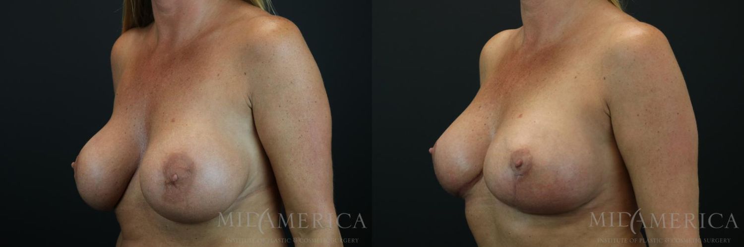 Implant Exchange Before & After